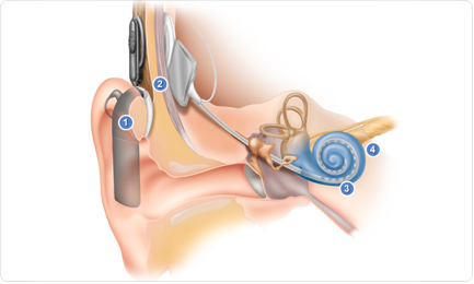 Image from cochlearamericas.com